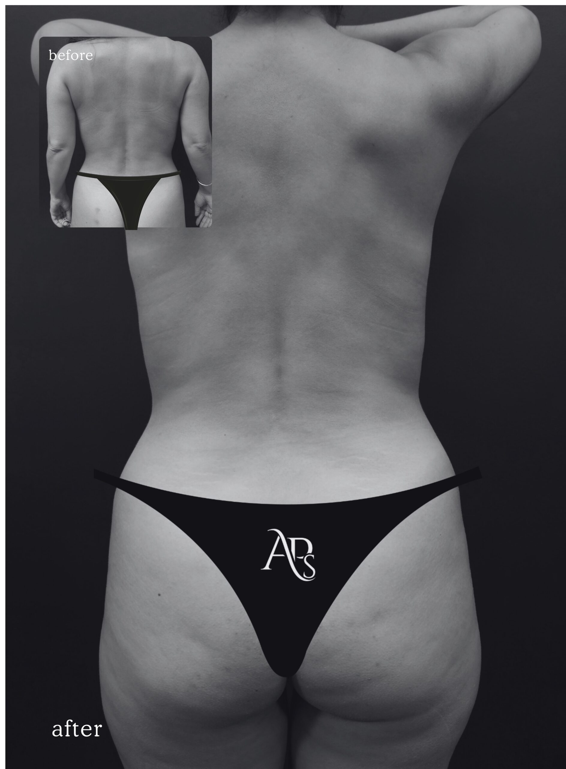 Mommy makeover with Brazilian butt lift for post-pregnancy body contouring