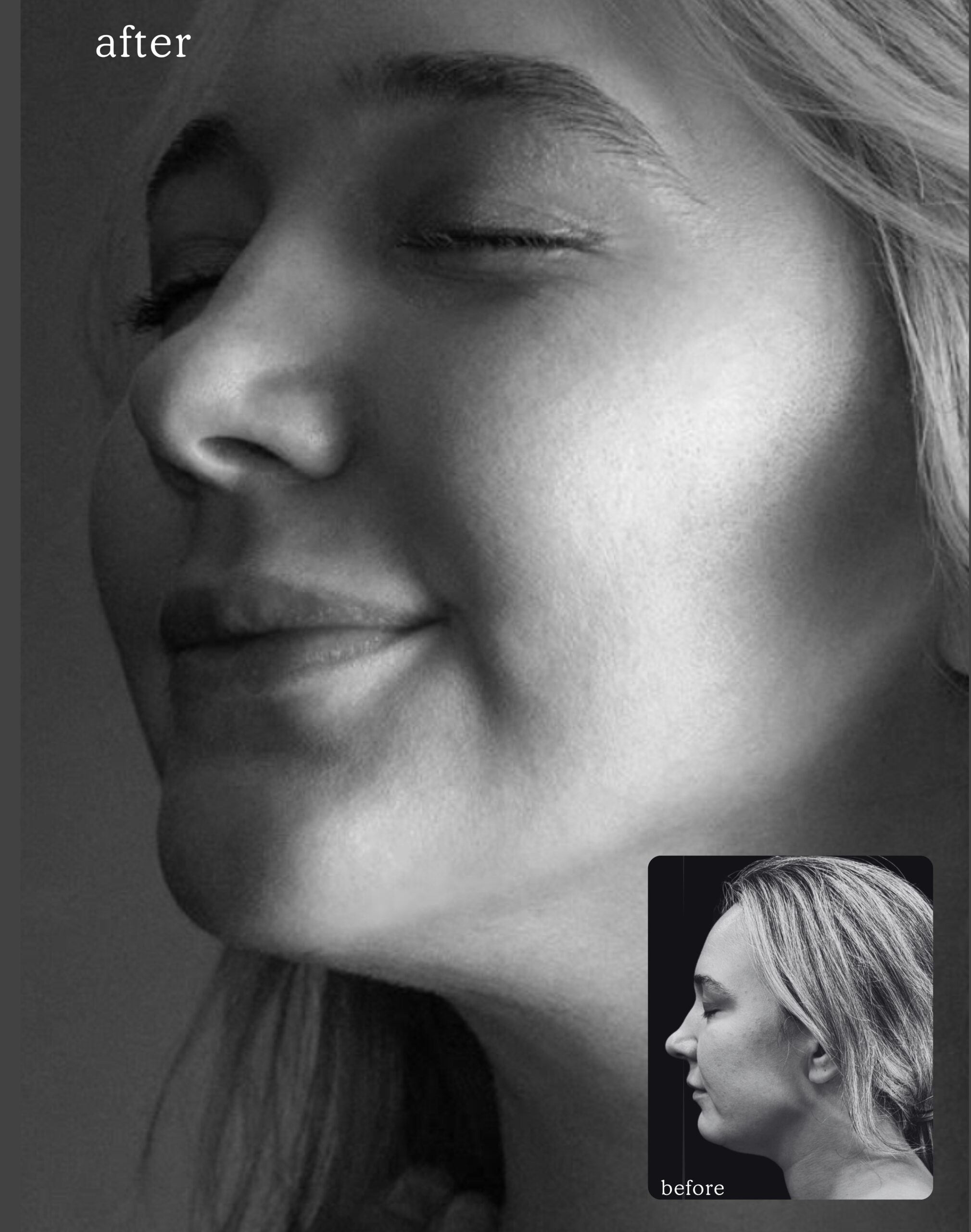 "Chin lift as part of Dr. Kevin Tehrani’s signature mommy makeover